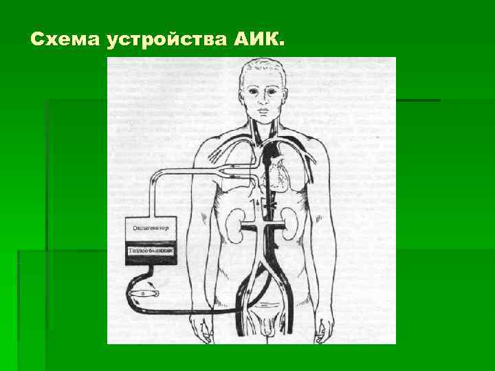 Схема устройства АИК. 