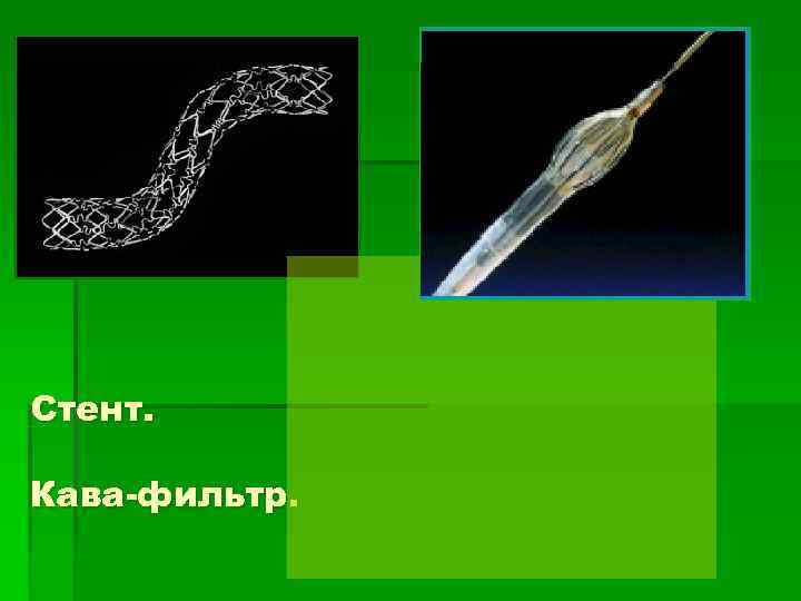 Стент.  Кава-фильтр. 