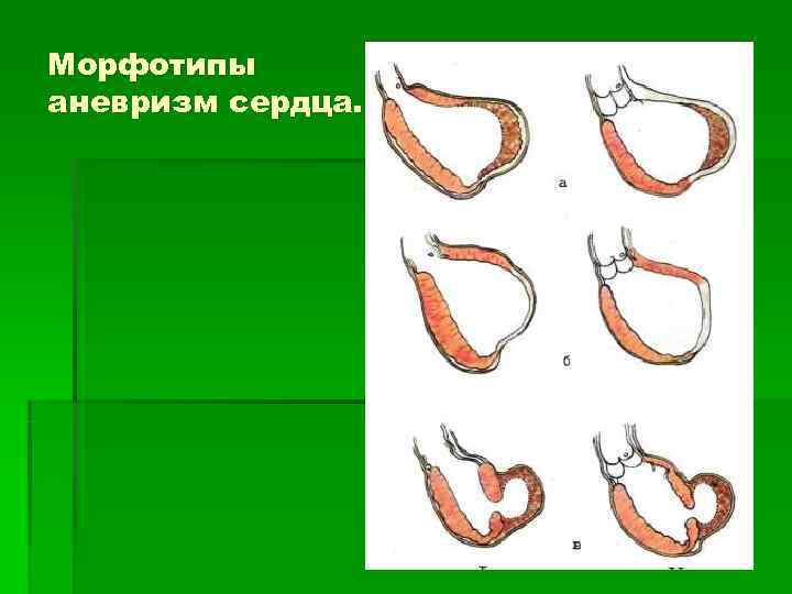 Морфотипы аневризм сердца. 