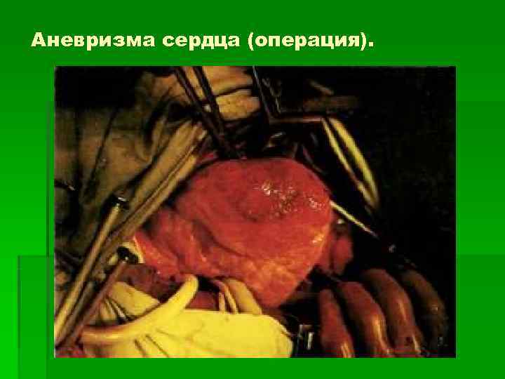 Аневризма сердца (операция). 