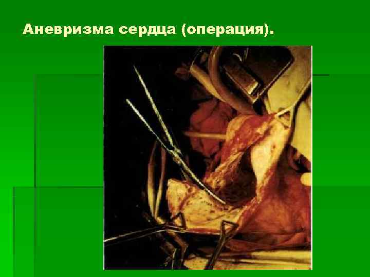 Аневризма сердца (операция). 