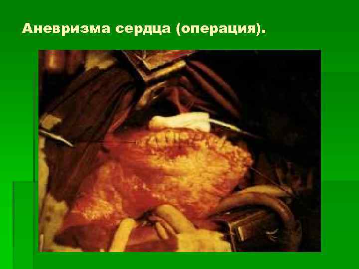 Аневризма сердца (операция). 