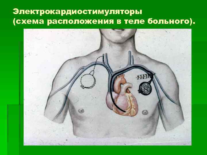 Электрокардиостимуляторы (схема расположения в теле больного). 