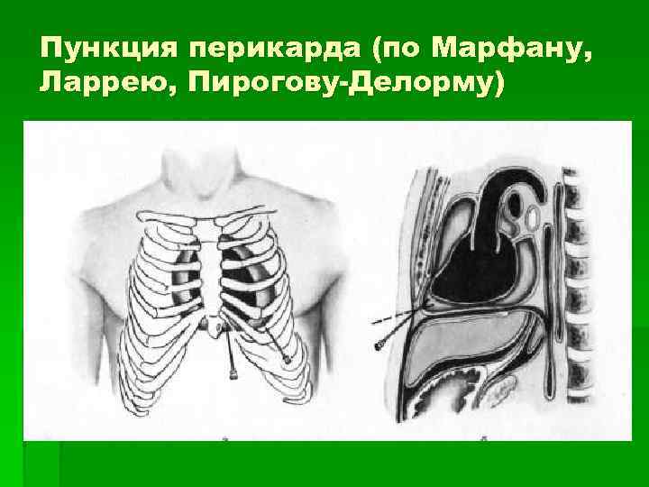 Пункция перикарда (по Марфану, Ларрею, Пирогову-Делорму) 