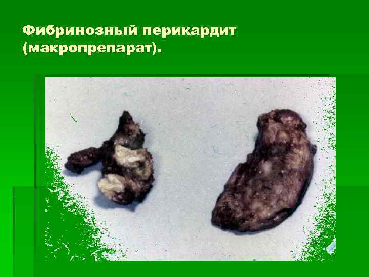 Фибринозный перикардит (макропрепарат). 