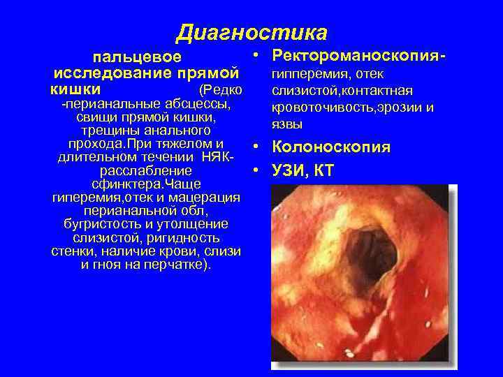    Диагностика пальцевое     • Ректороманоскопия- исследование прямой 