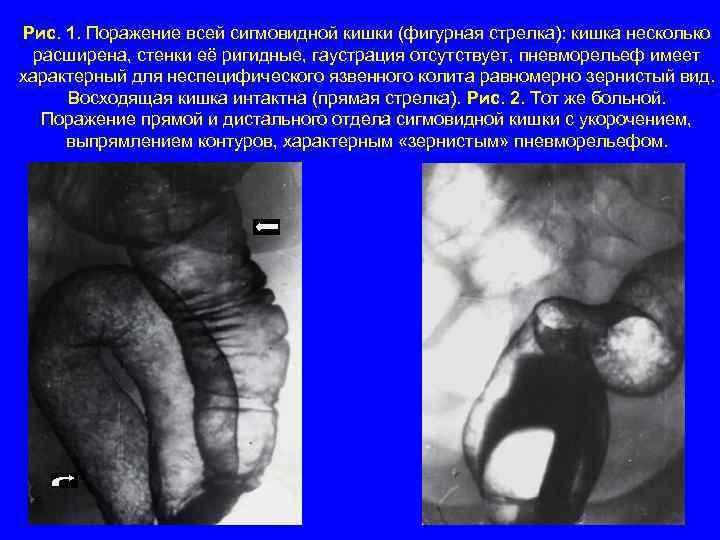  Рис. 1. Поражение всей сигмовидной кишки (фигурная стрелка): кишка несколько  расширена, стенки