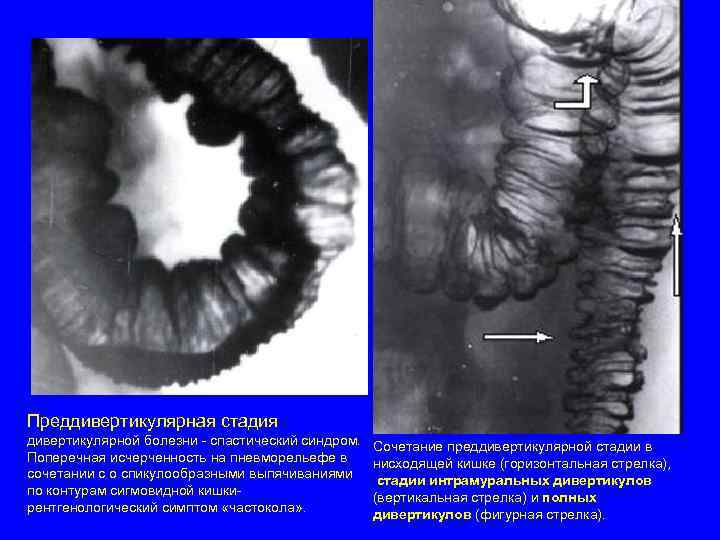 Преддивертикулярная стадия дивертикулярной болезни - спастический синдром. Сочетание преддивертикулярной стадии в Поперечная исчерченность на
