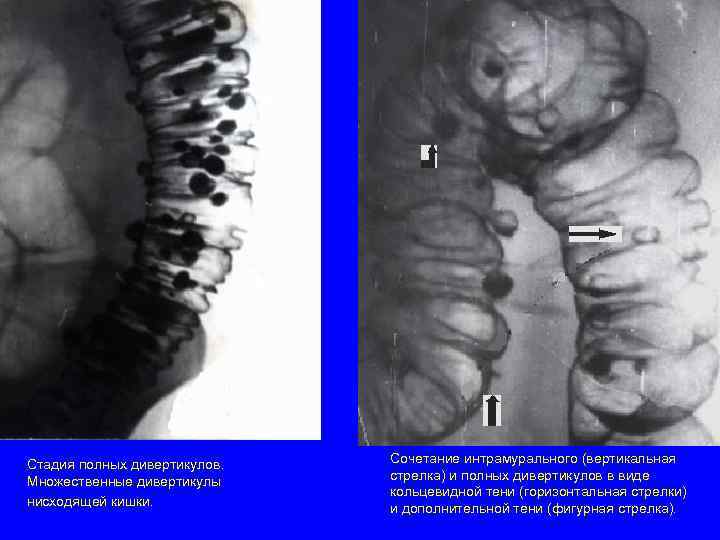Стадия полных дивертикулов. Сочетание интрамурального (вертикальная Множественные дивертикулы стрелка) и полных дивертикулов в виде