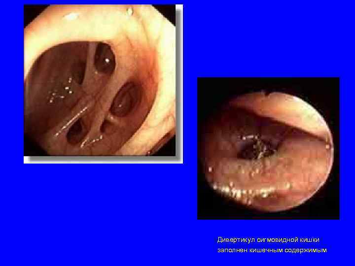 Дивертикул сигмовидной кишки заполнен кишечным содержимым 