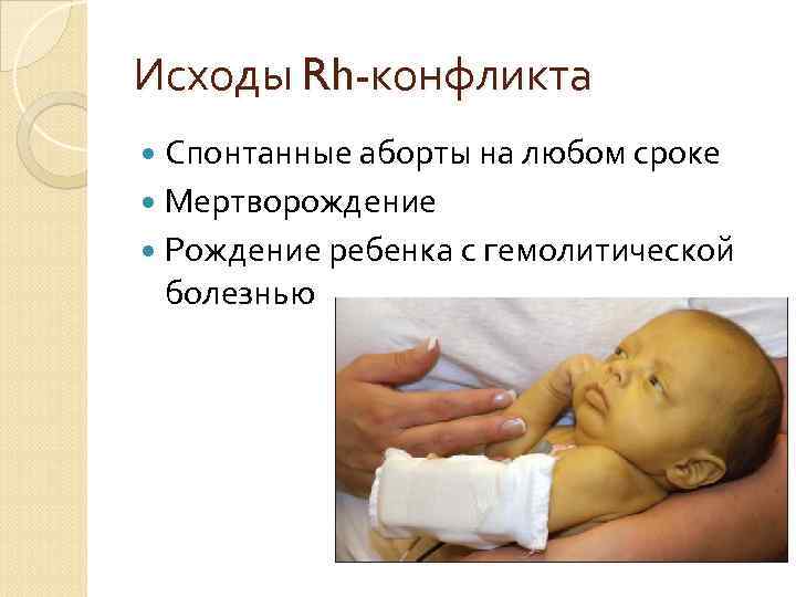 Исходы Rh-конфликта Спонтанные аборты на любом сроке Мертворождение Рождение ребенка с Исходы Rh-конфликта Спонтанные аборты на любом сроке Мертворождение Рождение ребенка с