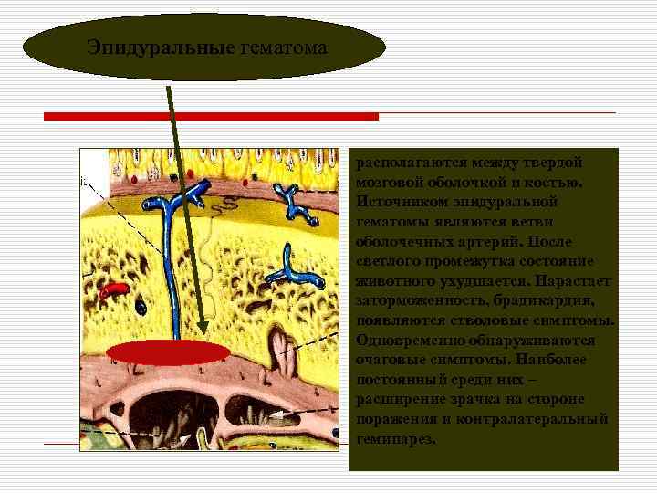 Эпидуральные гематома     располагаются между твердой     мозговой