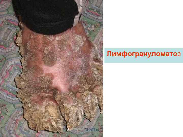 Лимфогрануломатоз 