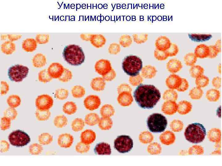  Умеренное увеличение числа лимфоцитов в крови 