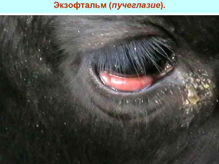 Экзофтальм (пучеглазие). 