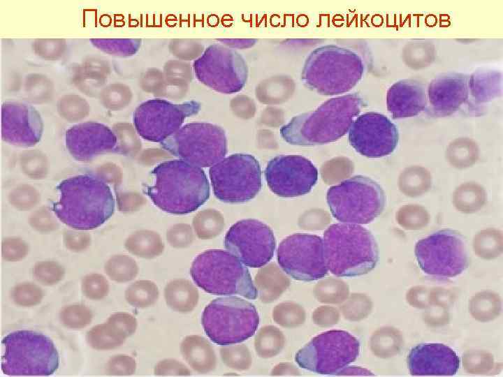 Повышенное число лейкоцитов 