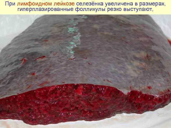 При лимфоидном лейкозе селезёнка увеличена в размерах,  гиперплазированные фолликулы резко выступают, 