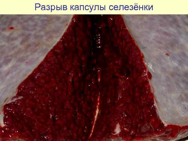 Разрыв капсулы селезёнки 