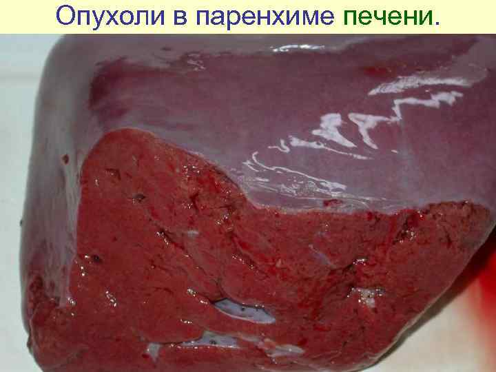 Опухоли в паренхиме печени. 