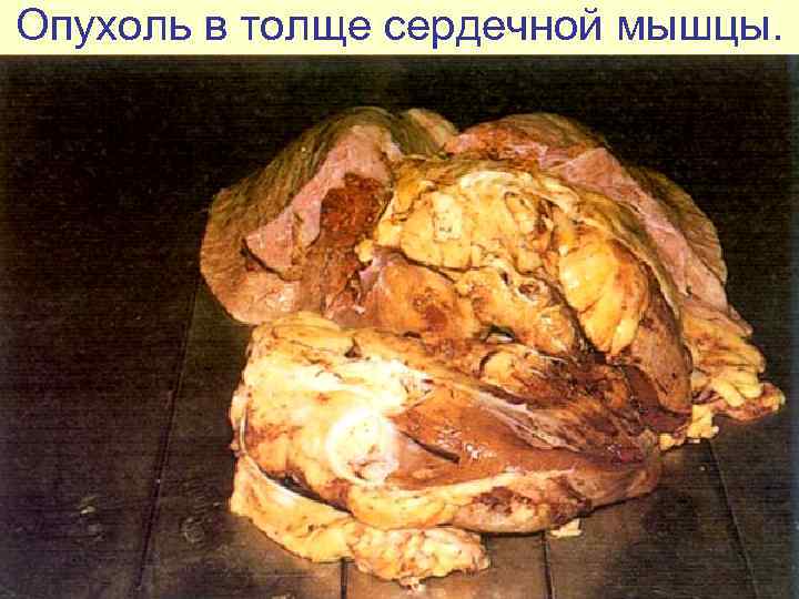 Опухоль в толще сердечной мышцы. 