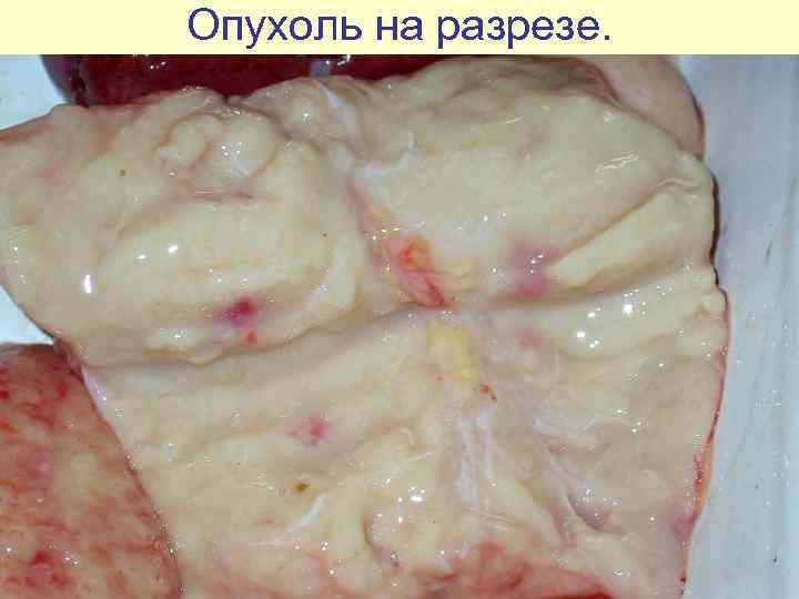 Опухоль на разрезе. 