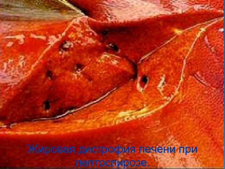 Жировая дистрофия печени при  лептоспирозе. 