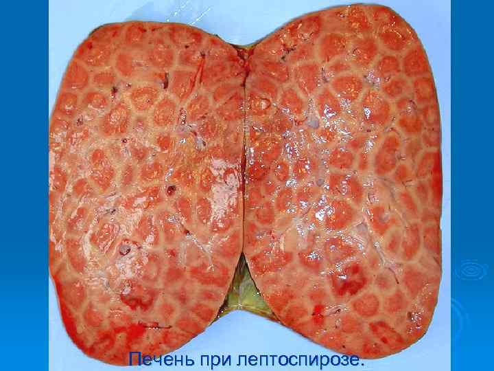 Печень при лептоспирозе. 