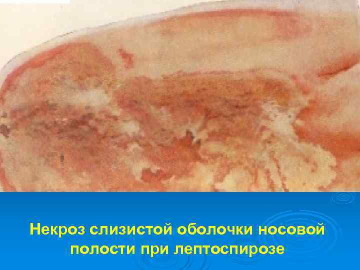 Некроз слизистой оболочки носовой полости при лептоспирозе 