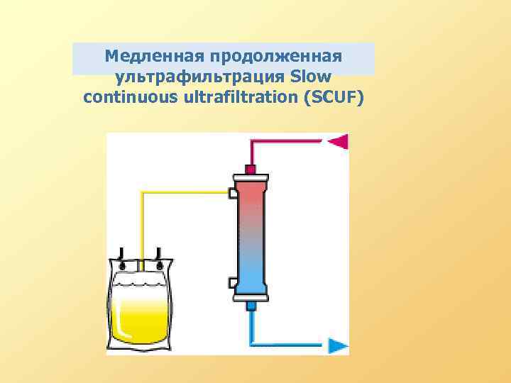 Медленная продолженная ультрафильтрация Slow continuous ultrafiltration (SCUF) 