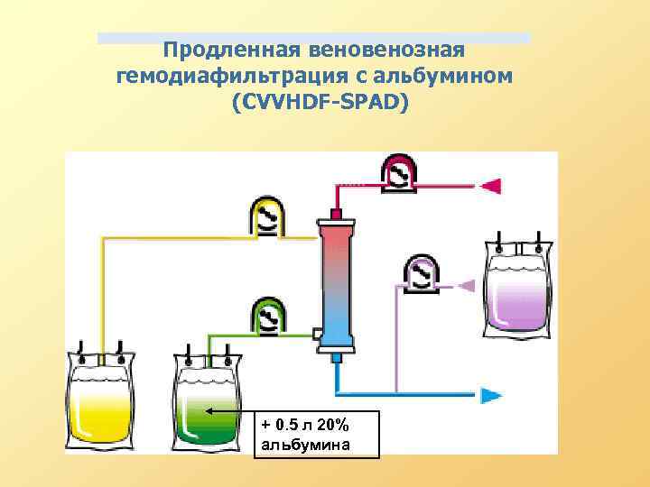 Продленная венозная гемодиафильтрация с альбумином (CVVHDF-SPAD) + 0. 5 л 20% альбумина 