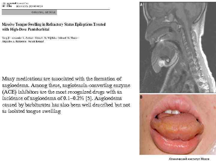 Many medications are associated with the formation of angioedema. Among these, angiotensin converting enzyme Many medications are associated with the formation of angioedema. Among these, angiotensin converting enzyme