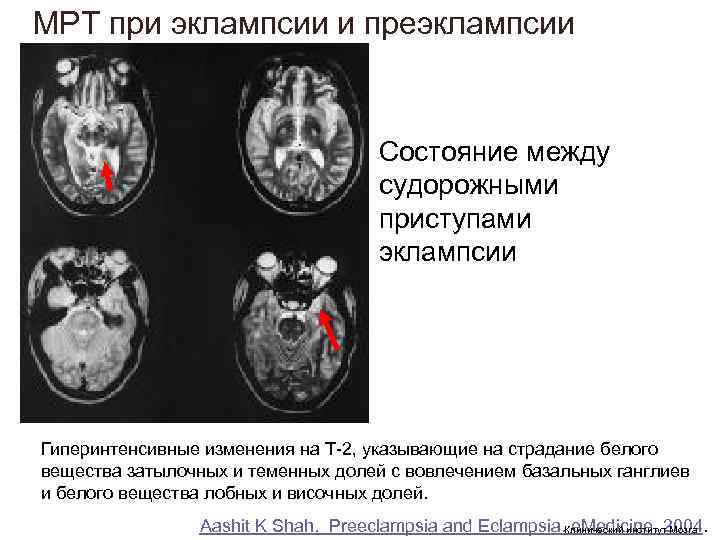 МРТ при эклампсии и преэклампсии Состояние между МРТ при эклампсии и преэклампсии Состояние между