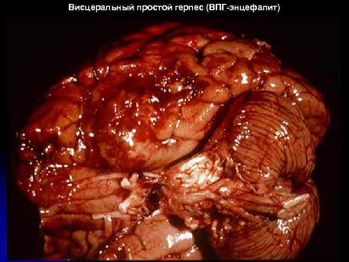 Висцеральный простой герпес (ВПГ-энцефалит) 