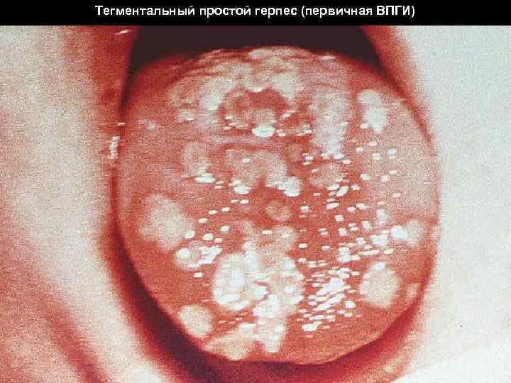 Тегментальный простой герпес (первичная ВПГИ) 