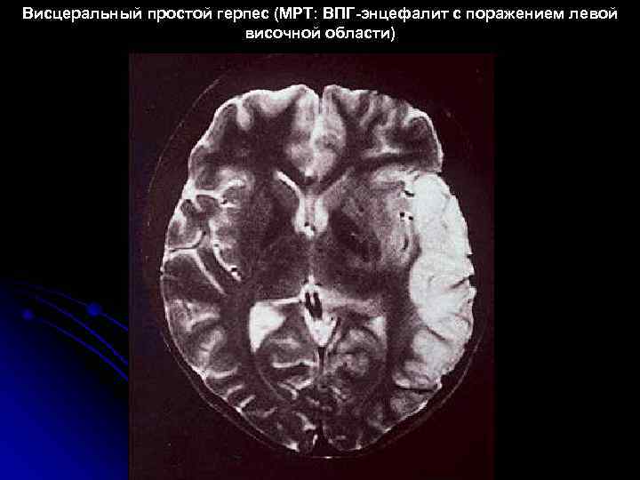 Висцеральный простой герпес (МРТ: ВПГ-энцефалит с поражением левой     височной области)