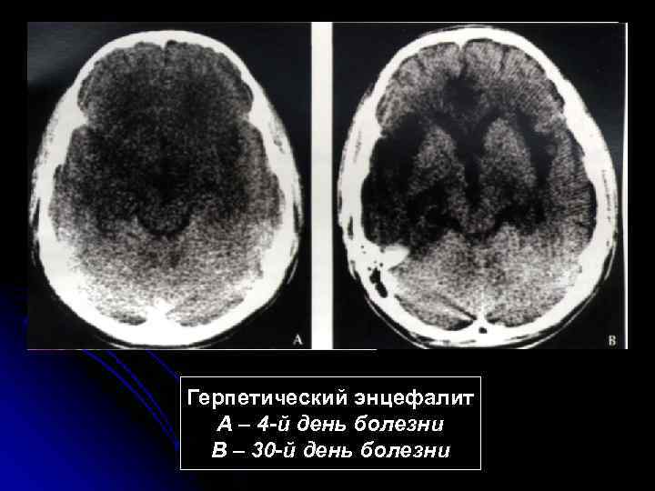 Герпетический энцефалит  А – 4 -й день болезни  В – 30 -й