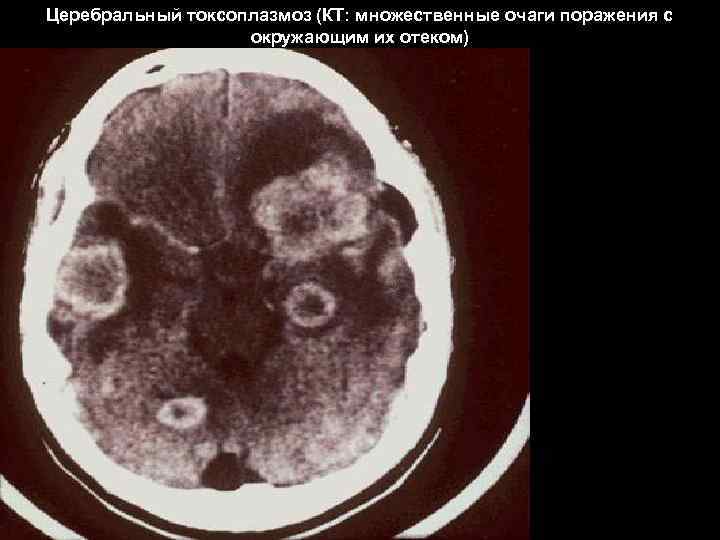 Церебральный токсоплазмоз (КТ: множественные очаги поражения с    окружающим их отеком) 