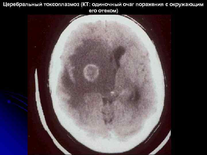 Токсоплазмоз головного мозга кт картина