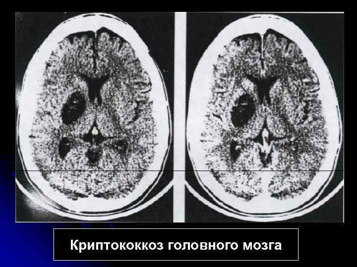 Криптококкоз головного мозга 