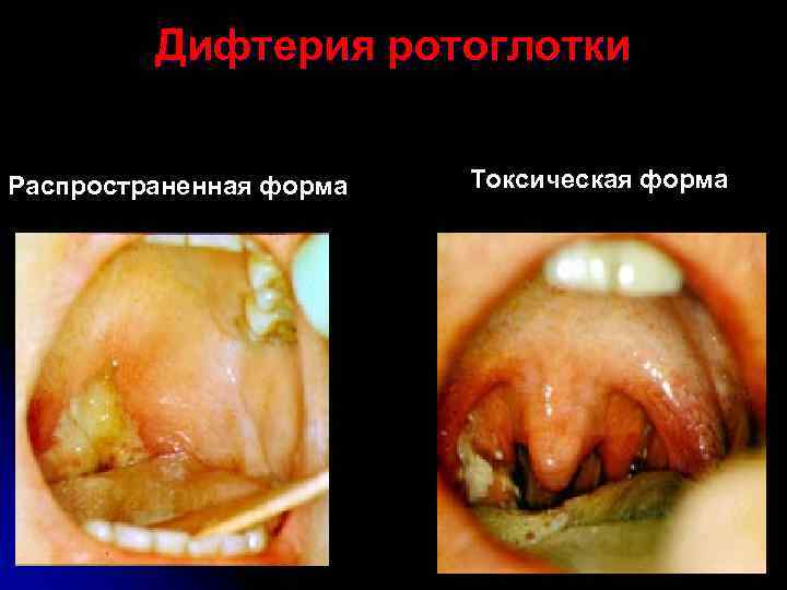    Дифтерия ротоглотки  Распространенная форма  Токсическая форма 