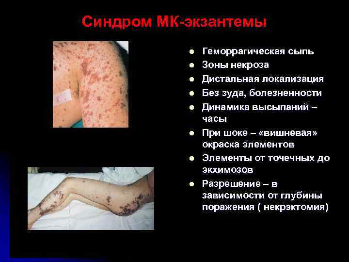Синдром МК-экзантемы  l  Геморрагическая сыпь  l  Зоны некроза  l