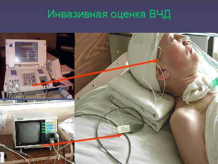 Инвазивная оценка ВЧД 