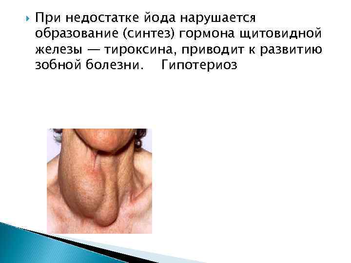   При недостатке йода нарушается образование (синтез) гормона щитовидной железы — тироксина, приводит