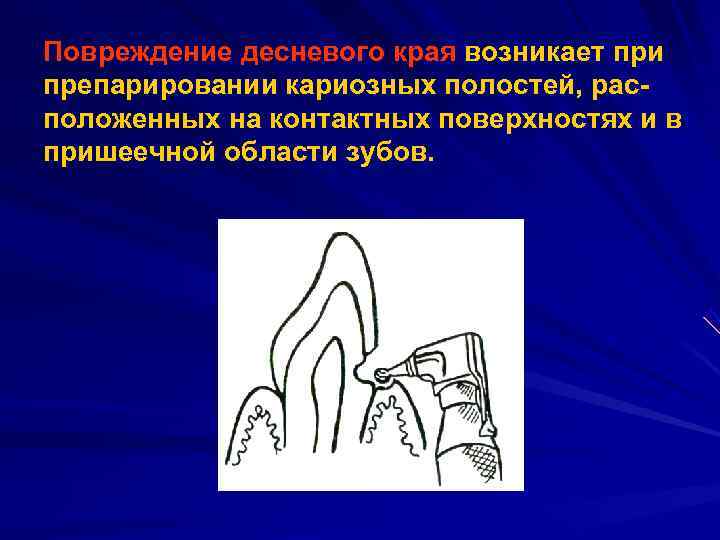 Повреждение десневого края возникает при препарировании кариозных полостей, рас положенных на контактных поверхностях и