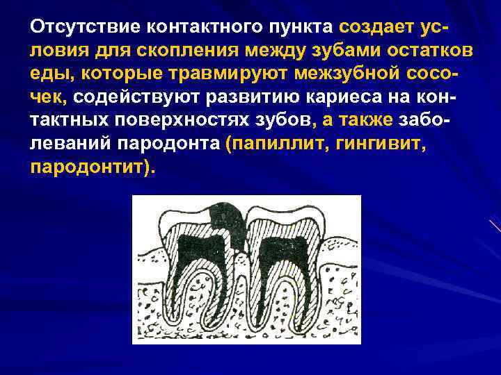 Отсутствие контактного пункта создает ус ловия для скопления между зубами остатков еды, которые травмируют