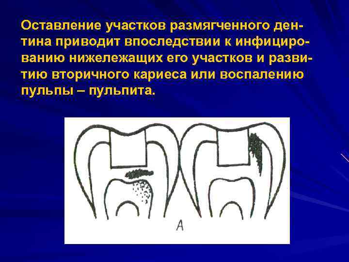 Оставление участков размягченного ден тина приводит впоследствии к инфициро ванию нижележащих его участков и