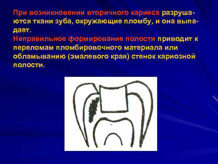 При возникновении вторичного кариеса разруша ются ткани зуба, окружающие пломбу, и она выпа дает.