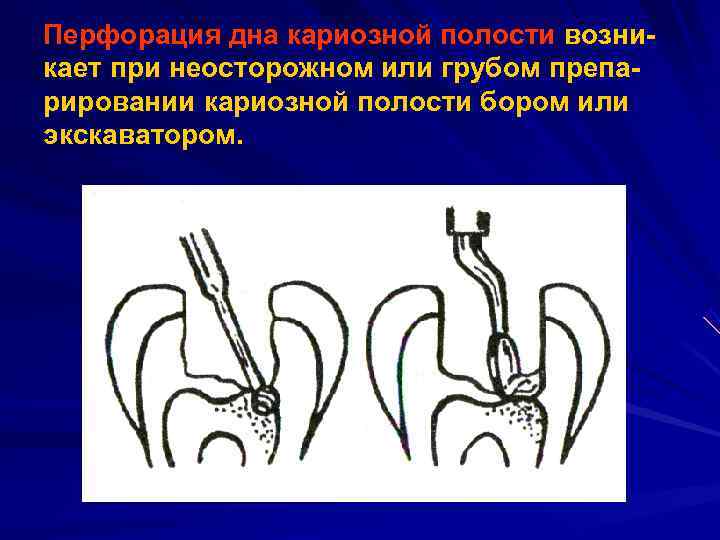 Перфорация дна кариозной полости возни кает при неосторожном или грубом препа рировании кариозной полости