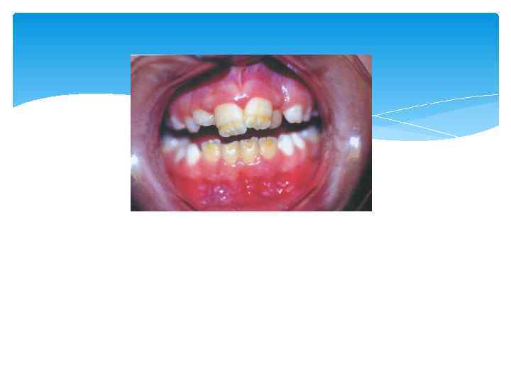   Слабая степень гипоплазии эмали может проявиться в виде белых, реже желтоватых пятен,