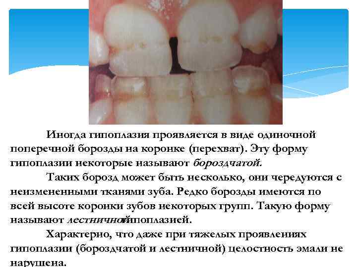 Некариозные поражения зубов после прорезывания зубов презентация